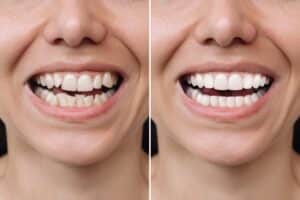 Cropped close-up of a young woman’s smile before and after veneer installation, showing corrected uneven teeth and whitening results