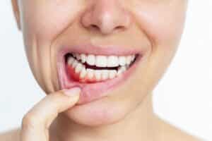 Close-up of a young woman’s mouth showing red, bleeding gums — common symptoms of gingivitis and gum inflammation, highlighting the need for professional dental care