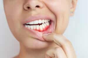A young woman reveals red, bleeding gums in a close-up image, showing signs of gum disease and gingival inflammation that may require bone grafting.