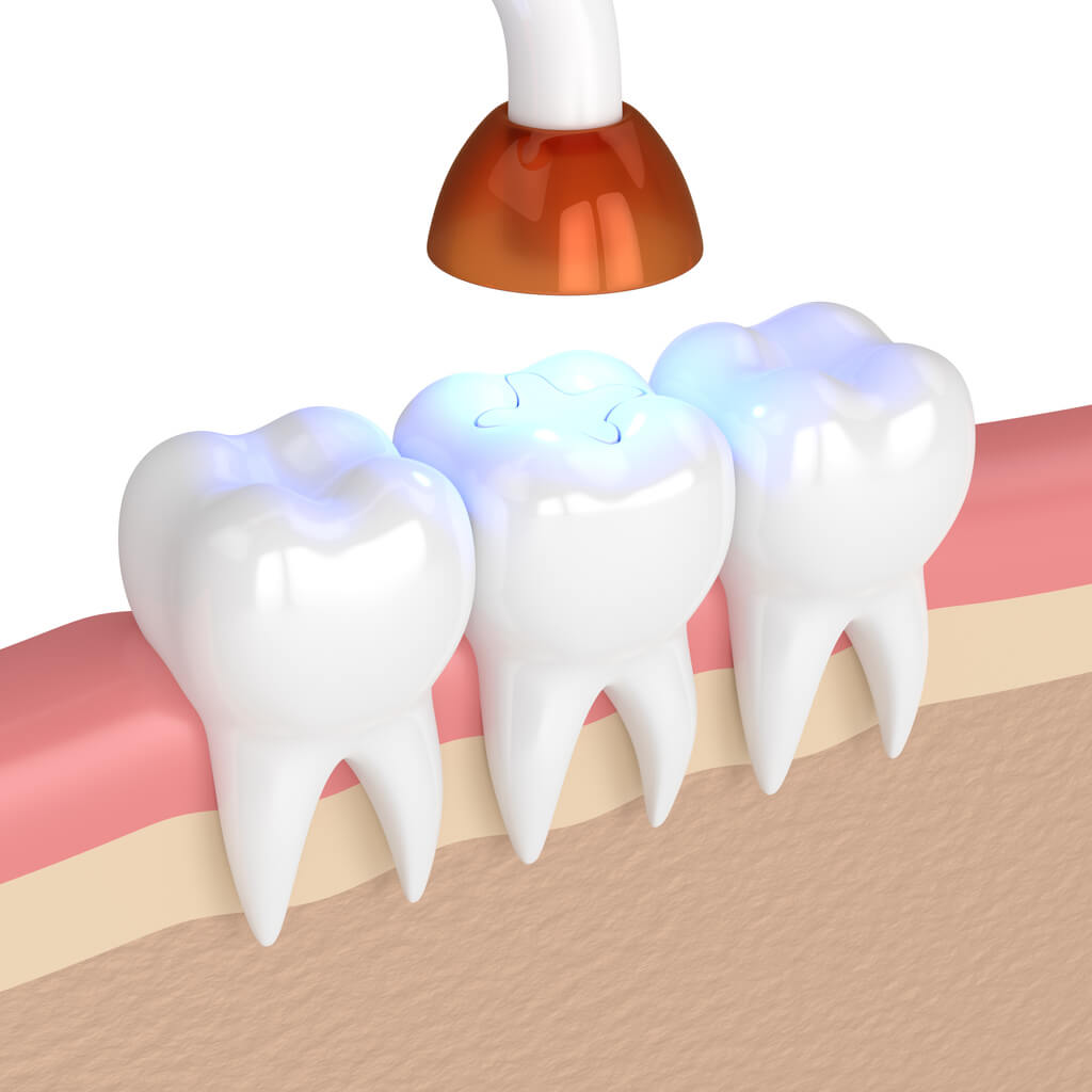 illustration of a tooth getting a filling