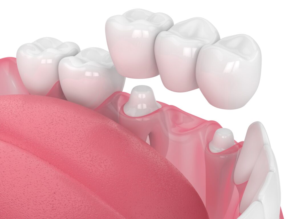 illustration of a dental bridge